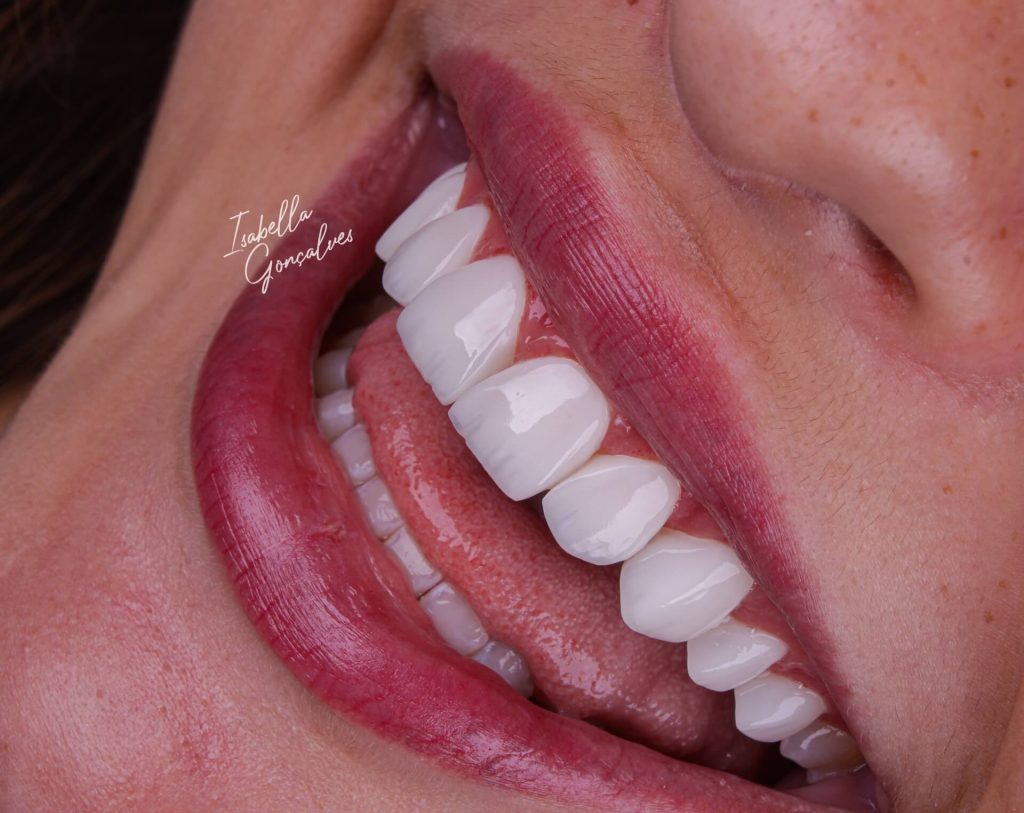 Dra Isabella Gonçalves - Sorriso com naturalidade - tn
